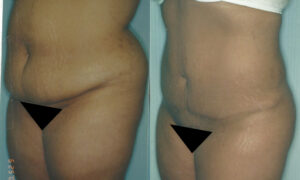 Patient 6a Liposuction Before and After