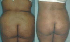 Patient 6b Liposuction Before and After