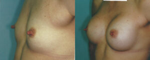 Patient 16b Breast Augmentation Before and After