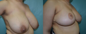 Patient 6b Breast Reduction Before and After