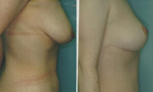 Patient 10a Tummy Tuck Before and After