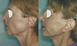 Patient 7c Facelift Before and After