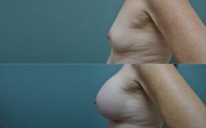 Patient 3b Breast Augmentation Before and After