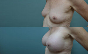 Patient 3c Breast Augmentation Before and After