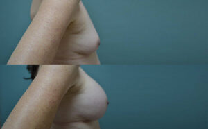 Patient 3d Breast Augmentation Before and After