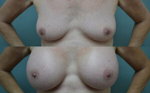 Patient 3a Breast Augmentation Before and After