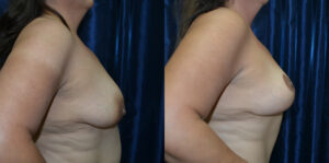 Patient 3a Breast Lift Before and After