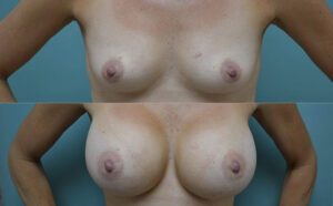 Patient 2c Breast Augmentation Before and After