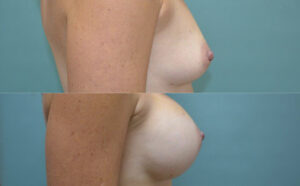 Patient 2d Breast Augmentation Before and After