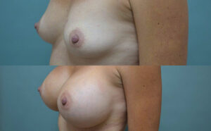 Patient 2e Breast Augmentation Before and After