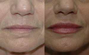 Patient 1a Dermabrasion Before and After