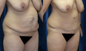 Patient 11c Tummy Tuck Before and After