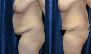 Patient 11b Tummy Tuck Before and After