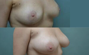 Patient 8b Breast Augmentation Before and After