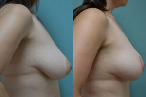 Patient 1c Breast Lift Before and After