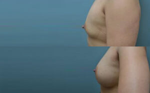 Patient 9a Breast Augmentation Before and After