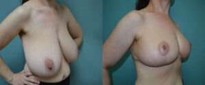 Patient 4b Breast Reduction Before and After