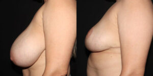 kaweski-san-diego-breast-reduction-_patient-12-3