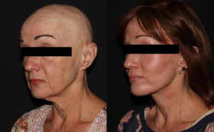 kaweski-san-diego-facelift-_Patient-9-1