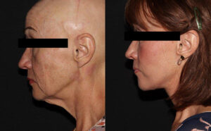 kaweski-san-diego-facelift-_Patient-9-2