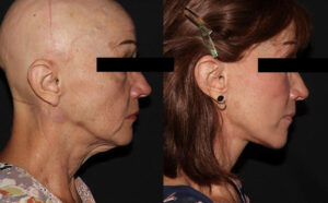 kaweski-san-diego-facelift-_Patient-9-3