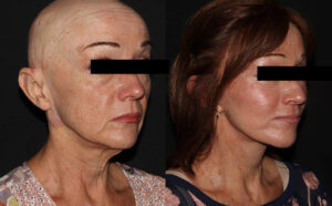 kaweski-san-diego-facelift-_Patient-9-4