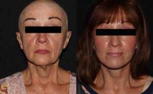 kaweski-san-diego-facelift-_Patient-9-5