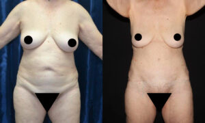 Patient 12a Tummy Tuck Before and After