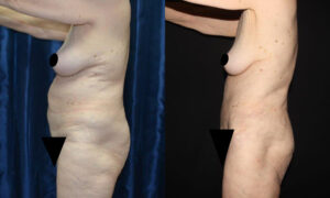 Patient 12c Tummy Tuck Before and After