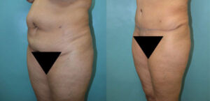 Patient 6a Tummy Tuck Before and After