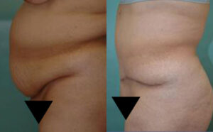 Patient 7a Tummy Tuck Before and After