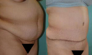 Patient 7b Tummy Tuck Before and After