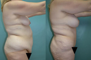 Patient 5a Tummy Tuck Before and After