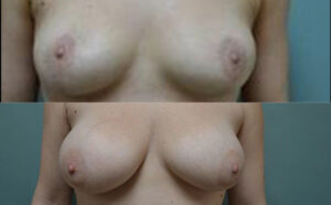 Patient 8a Breast Augmentation Before and After