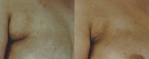 Patient 5a Liposuction Before and After