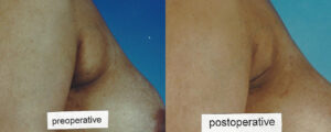 Patient 5b Liposuction Before and After