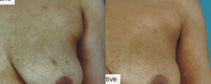 Patient 5c Liposuction Before and After