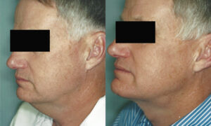 Patient 2b Neck Lift Before and After