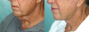 Patient 1c Neck Lift Before and After