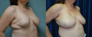 Patient 1b Breast Reconstruction