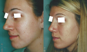 Patient 3b Rhinoplasty Before and After