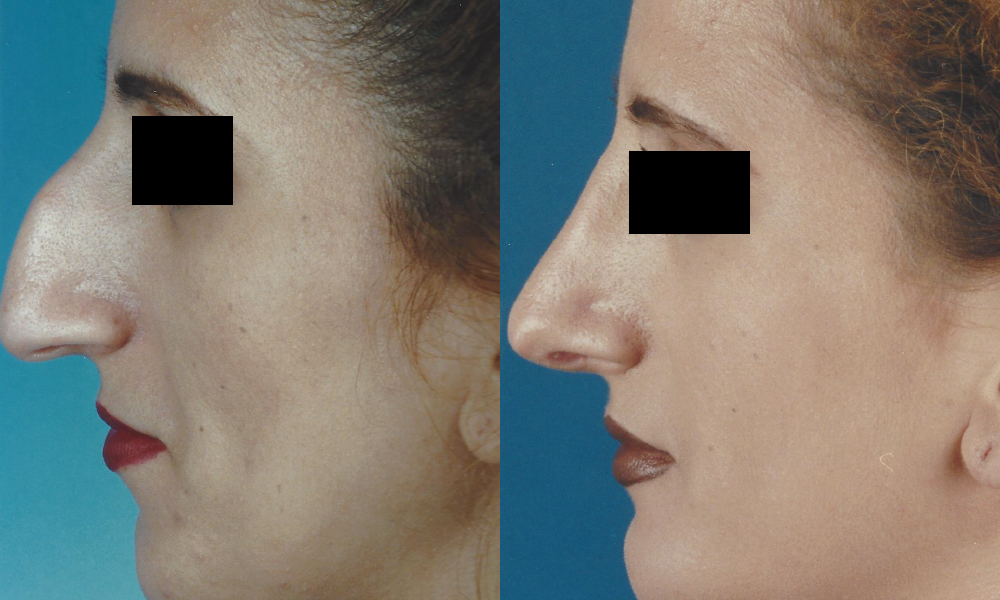 Patient 1a Rhinoplasty Before and After