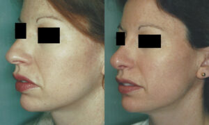 Patient 2b Rhinoplasty Before and After