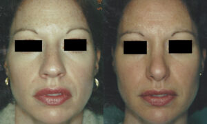 Patient 2c Rhinoplasty Before and After