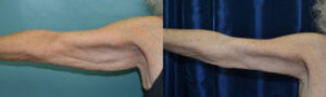 Patient 4c Arm Lift Before and After