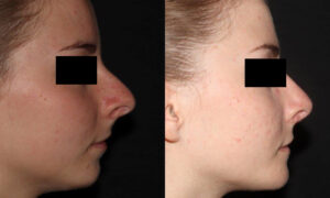 kaweski-san-diego-rhinoplasty-_patient-5-1