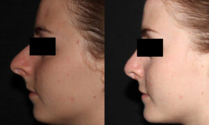 kaweski-san-diego-rhinoplasty-_patient-5-2