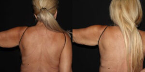 Patient 6a CoolSculpting Before and After