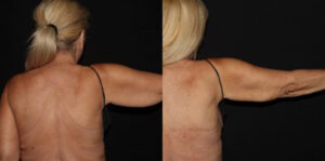 Patient 6b CoolSculpting Before and After