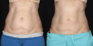 Patient 8b CoolSculpting Before and After